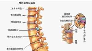 佛教说腰椎间盘治疗 佛教说腰椎间盘治疗是真的吗