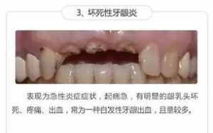 牙龈出血因果 佛教解释牙龈出血