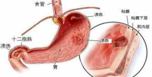 佛教治疗胃病的方法 佛教胃炎