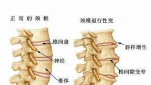 佛教对颈椎病的原因 佛家看颈椎疼的原因