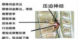 佛教与腰椎间盘突出 佛教说腰间盘突出