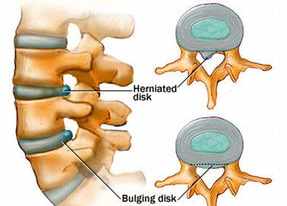 佛教与腰椎间盘突出 佛教说腰间盘突出