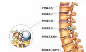 佛教与腰椎间盘突出 佛教说腰间盘突出