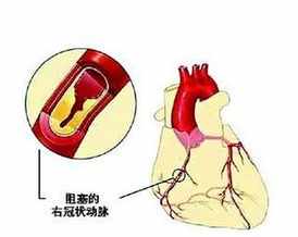 佛教冠心病怎样调理 佛教对心脏病解释