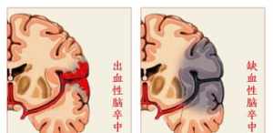 佛教脑梗塞怎么办 佛家说脑梗是什么因果