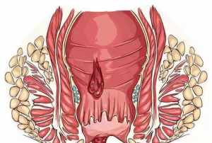 佛教如何看痔疮 佛教痔疮病是什么因缘