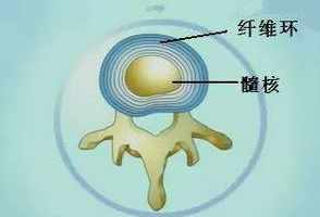 盘突出能治好吗 佛教盘突出