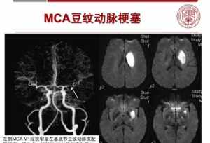 佛教脑血管病是什么因果 佛教解释脑血管病