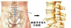 佛教开示腰椎 佛家治疗腰椎盘突出的咒语