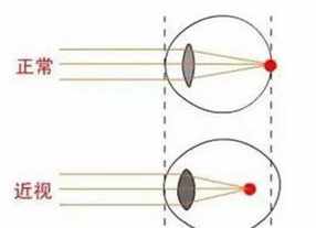 佛教怎么治疗近视眼 佛法治疗近视的例子