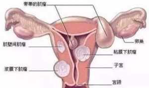 子宫肌瘤对应佛教因果 子宫肌瘤的咒语