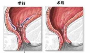 佛说疗痔疮经 佛教如何治痔疮