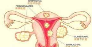 子宫肌瘤的因果报应 子宫肌瘤对应佛教因果对照