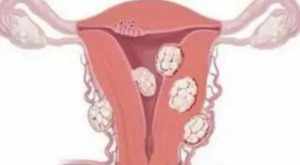 子宫肌瘤的因果报应 子宫肌瘤对应佛教因果对照