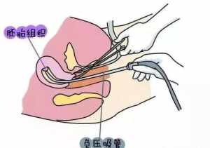 佛教怎么处理流产的胎儿 佛教对待流产的孩子