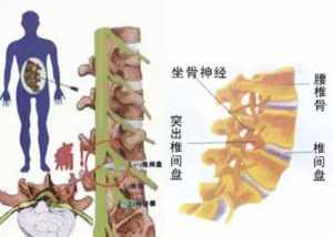 佛教谈腰间盘突出 从佛教的角度看腰间盘突出