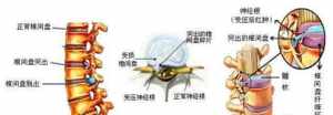 佛教谈腰间盘突出 从佛教的角度看腰间盘突出