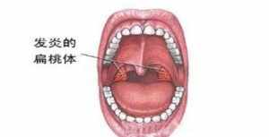 佛说咽喉炎的因果 佛教咽喉病