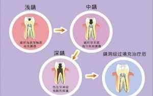 佛教蛀牙 佛教蛀牙的因果