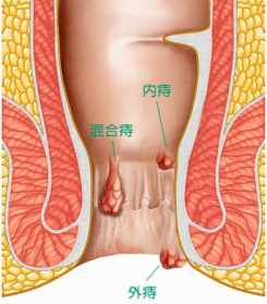 疗痔病此咒佛教 佛说疗痔病神咒