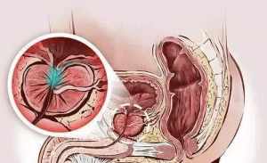 佛法治疗前列腺炎 佛教前列腺炎