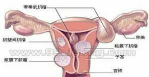 念佛治愈子宫肌瘤 佛教得子宫肌瘤的缘由