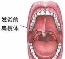 喉咙不好佛教解释 佛说咽喉病