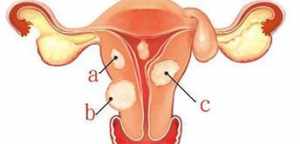 佛教如何看待子宫肌瘤 佛教子宫肌瘤属于业障病吗
