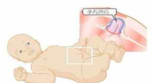 孩子疝气是父母业障吗 佛教解释孩子得疝气