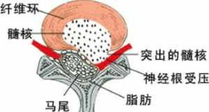 佛教腰椎间盘突出 腰椎盘突出的佛教因果