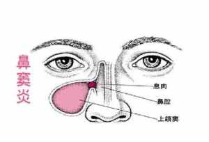 鼻炎在佛教怎么治 信佛教可能治疗鼻炎吗