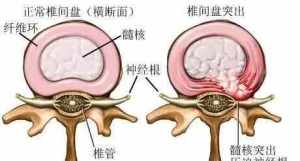 腰间盘突出佛教因果 佛教腰间盘突出的因果