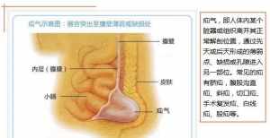 佛教讲小儿得疝气的因果 小儿疝气对身体的影响