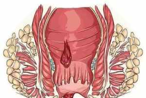 佛教中痔疮 佛教对痔疮的因果解释