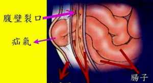 佛教解释孩子得疝气 佛教解释疝气的因果