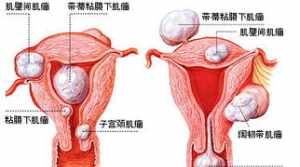 学佛网子宫肌瘤是什么果报 佛教如何看待子宫肌瘤