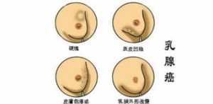 乳腺癌佛教 乳腺癌的业障