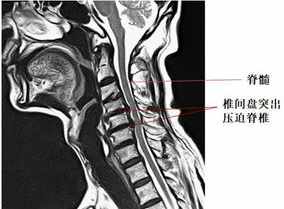 佛法颈椎病的因果和对治 佛教可以治疗颈椎病吗