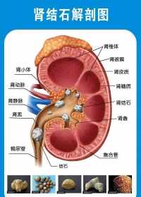 佛学肾结石怎么引起 佛法讲肾结石是什么原因