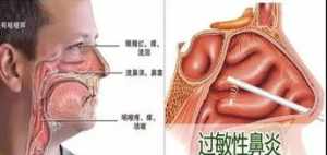 佛学鼻炎是怎么回事 佛教 鼻炎因果关系