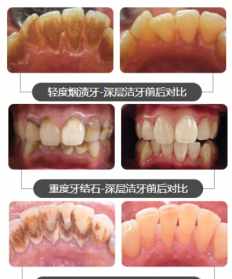 佛牙怎么变白 学佛后牙变白