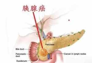 观音菩萨胰腺癌 念观音菩萨圣号治癌