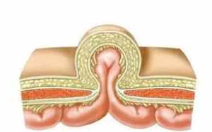 小孩得疝气是不是遗传 佛教解释孩子得疝气