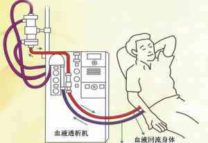 佛法治好尿毒症真实案例 念佛治尿毒症