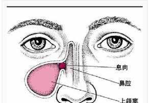 佛教讲鼻炎的果报 佛法鼻窦炎是什么因