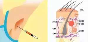 佛教怎么治腋臭 佛教对于狐臭的开示