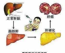 学佛治好脂肪肝 讲座治疗脂肪肝