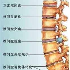 腰椎间盘突出在佛教里里是什么业障 学佛人腰椎盘突出