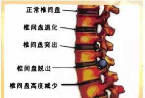 腰间盘突出佛教因果 佛教腰间盘突出的因果