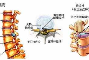 腰间盘突出佛教因果 佛教腰间盘突出的因果